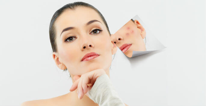 Anti Acne Facial